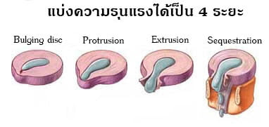 รักษาอาการปวดหลัง,บำบัดอาการปวดหลัง,ปวดหลัง,กระดูกทับเส้น,backpain,backpainhelp,หมอนรองกระดูกทับเส้นประสาท,office syndrome,สถาบันสอนว่ายน้ำ,ยึดเส้นประสาท