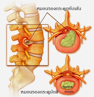รักษาอาการปวดหลัง,บำบัดอาการปวดหลัง,ปวดหลัง,กระดูกทับเส้น,backpain,backpainhelp,หมอนรองกระดูกทับเส้นประสาท,office syndrome,สถาบันสอนว่ายน้ำ,ยึดเส้นประสาท